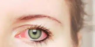 Um alerta sobre o Glaucoma