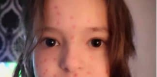 Menininha de 6 anos pinta todo o corpo para simular catapora e não ir para a escola