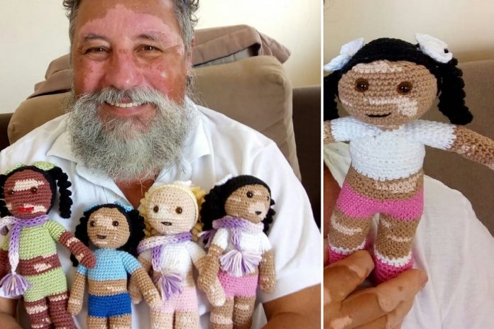 Avô faz bonecas de crochê com vitiligo para aumentar a auto-estima das crianças com a doença
