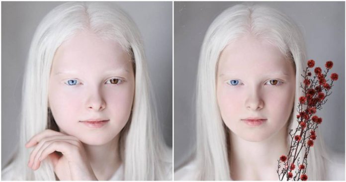 Com albinismo e heterocromia, conheça a rara e inesquecível beleza de Amina Ependevia