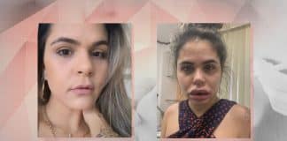 Mulheres denunciam dentista após harmonização facial: rostos deformados