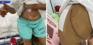 Jovem de 19 anos tem parte do pulmão retirado após diagnóstico de fungo causado por narguilé