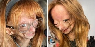 Adalia Rose, youtuber com ‘síndrome de Benjamin Button’ falece aos 15 anos: ‘Tocou o coração de milhões’, diz família