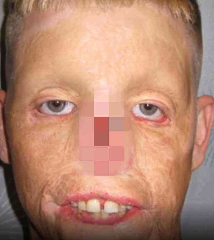 revistapazes.com - Após acidente, homem reconstrói sua vida graças a transplante de rosto: "Fiz isso pelos meus filhos"