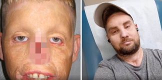 Após acidente, homem reconstrói sua vida graças a transplante de rosto: “Fiz isso pelos meus filhos”