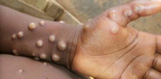 Alerta: Madri já confirma 30 casos de varíola de macaco