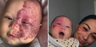 Pais são criticados após submeter bebê de 4 meses a laser para retirar marca de nascença