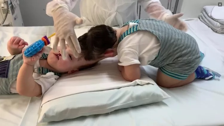 revistapazes.com - Gêmeos unidos pelo crânio são separados no RJ após 9 cirurgias 100% custeadas pelo SUS
