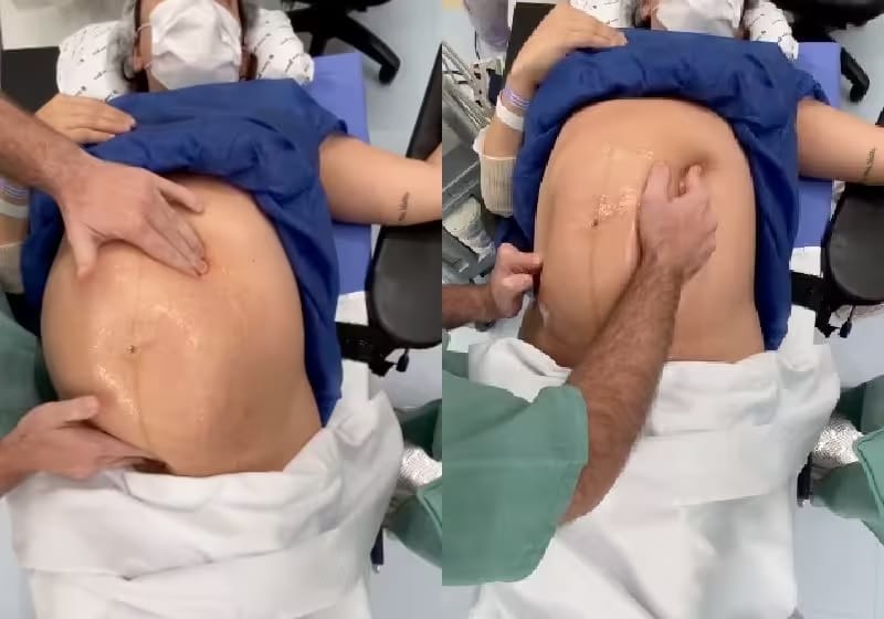 revistapazes.com - Médico 'vira' bebê dentro da barriga da mãe minutos antes do parto e evita cesariana - ASSISTA!