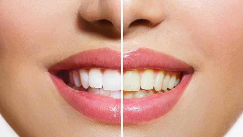 revistapazes.com - Deixe seus dentes brancos em pouco tempo: confira esta receita caseira aprovada por dentista