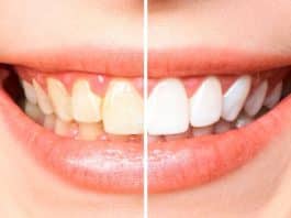 Deixe seus dentes brancos em pouco tempo: confira esta receita caseira aprovada por dentista