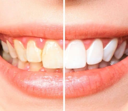 Deixe seus dentes brancos em pouco tempo: confira esta receita caseira aprovada por dentista