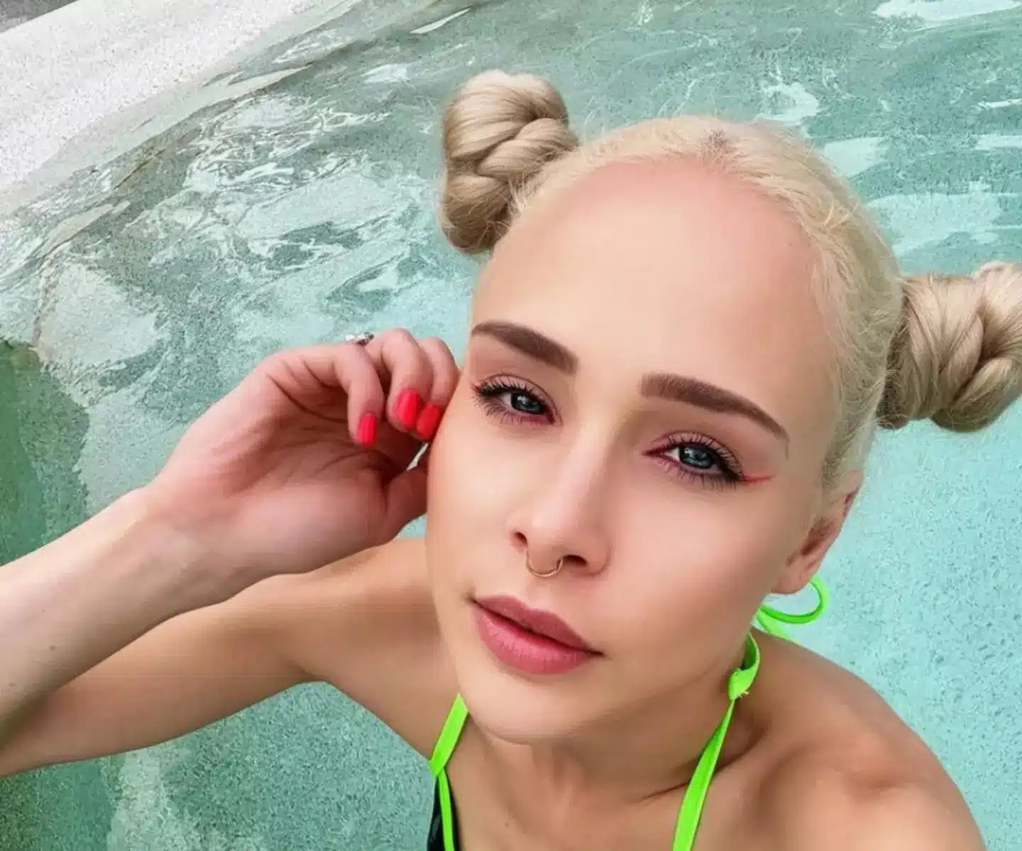 revistapazes.com - Mulher que pagou quase R$ 1 milhão para alongar as pernas em 14 cm está com doença crônica após cirurgia