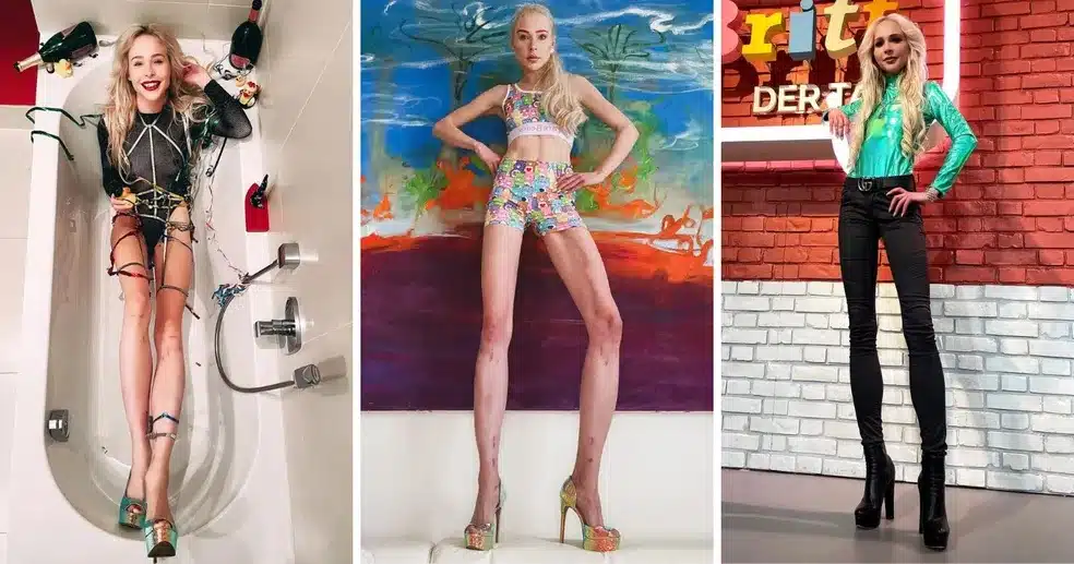 revistapazes.com - Mulher que pagou quase R$ 1 milhão para alongar as pernas em 14 cm está com doença crônica após cirurgia