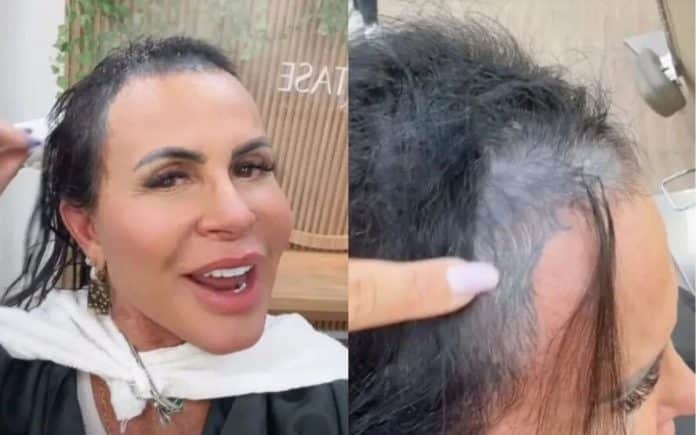 Corte químico e alopecia: entenda o problema capilar de Gretchen que tem feito com que ela perca o cabelo