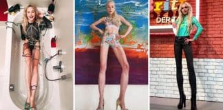 Mulher que pagou quase R$ 1 milhão para alongar as pernas em 14 cm está com doença crônica após cirurgia