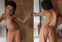 Madrasta luta para conseguir cirurgia de enteado que possui escoliose gravíssima: 'Amo ele como se fosse meu filho'