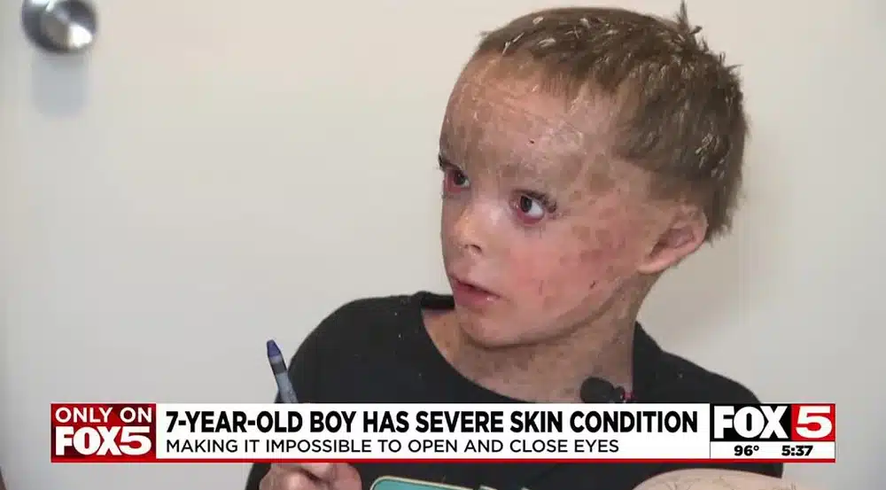 Menino de 7 anos com condição raríssima de pele consegue dormir com os olhos fechados pela 1ª vez após cirurgia que mudou sua vida revistapazes.com - Menino de 7 anos com condição raríssima de pele consegue dormir com os olhos fechados pela 1ª vez após cirurgia que mudou sua vida