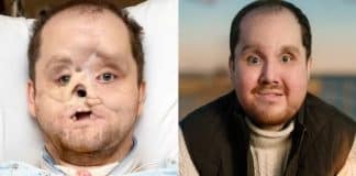 Homem recebe transplante de rosto inovador e recupera capacidade de sorrir e piscar – veja fotos do antes e depois