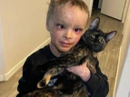 Menino de 7 anos com condição raríssima de pele consegue dormir com os olhos fechados pela 1ª vez após cirurgia que mudou sua vida