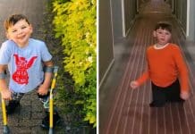 Menino de 10 anos que sofreu amputações devido a abusos dos pais volta a andar após cirurgia "milagrosa"