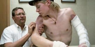 Jovem que perdeu os 2 braços em um acidente conseguiu reimplantá-los após ligar para hospital usando um lápis