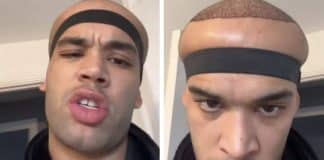 Homem que fez transplante capilar em clínica de celebridades revela resultados e é comparado ao “Megamente” por internautas