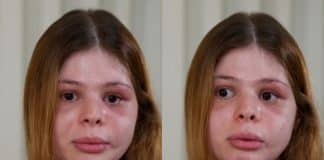 Médica é brutalmente agredida pelo namorado no dia do aniversário e relata como teve o rosto desfigurado