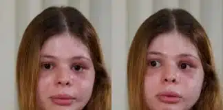 Médica é brutalmente agredida pelo namorado no dia do aniversário e relata como teve o rosto desfigurado