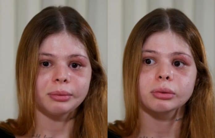 Médica é brutalmente agredida pelo namorado no dia do aniversário e relata como teve o rosto desfigurado