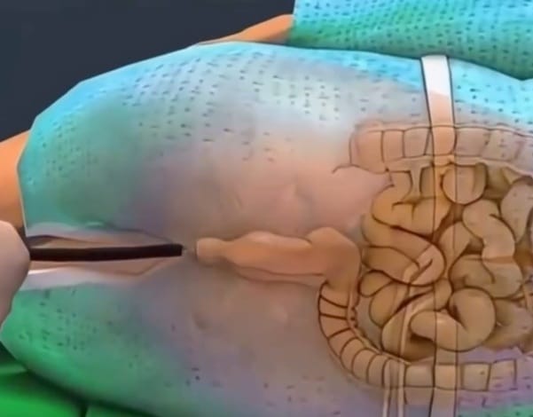 revistapazes.com - 30 anos, 45 ou 60? M&eacute;dico brasileiro explica qual &eacute; a idade ideal para marcar colonoscopia e faz alerta