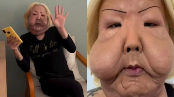 juju do pix cirurgia 2026 O que o óleo industrial causou no rosto de Juju do Pix? Médico mostra resultado após cirurgia