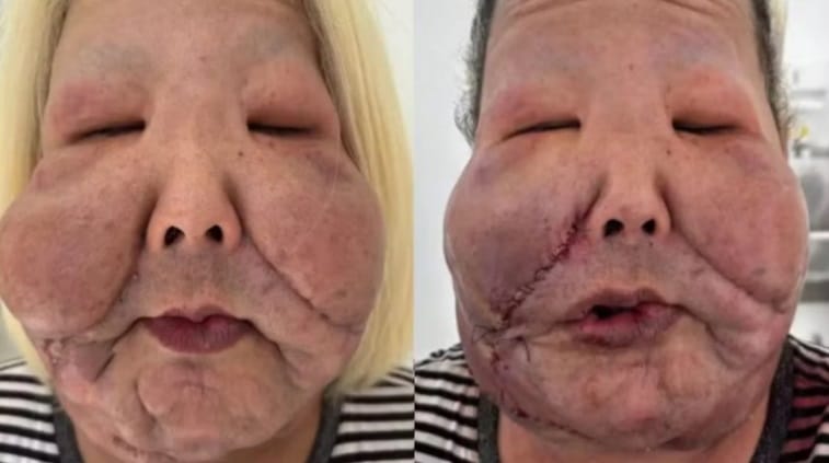 O que o óleo industrial causou no rosto de Juju do Pix? Médico mostra resultado após cirurgia revistapazes.com - O que o óleo industrial causou no rosto de Juju do Pix? Médico mostra resultado após cirurgia