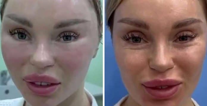 Ela diz ter amado a cirurgia plástica, mas o antes e depois deixou a internet dividida