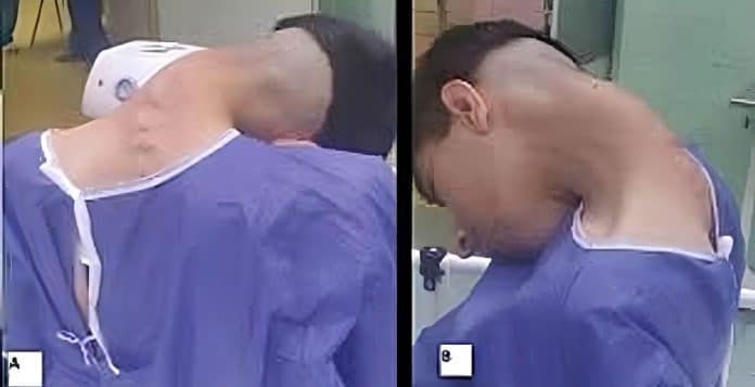 Jovem de 23 anos desenvolve condição rara chamada “síndrome da cabeça caída” por causa de hábito ridículo