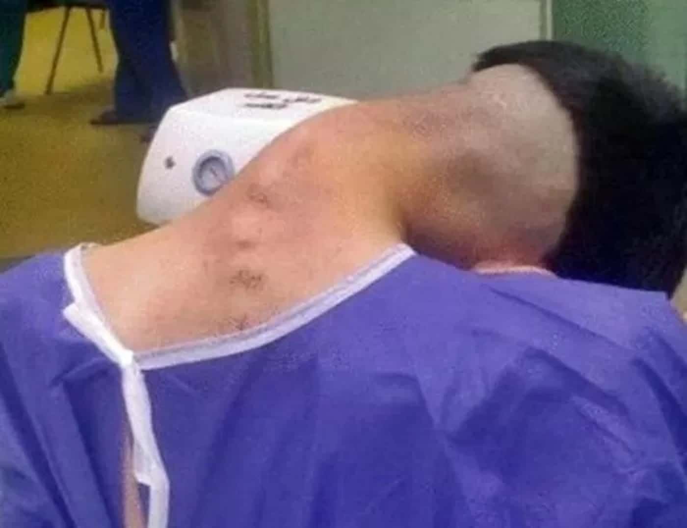 revistapazes.com - Jovem de 23 anos desenvolve condi&ccedil;&atilde;o rara chamada &ldquo;s&iacute;ndrome da cabe&ccedil;a ca&iacute;da&rdquo; por causa de h&aacute;bito rid&iacute;culo