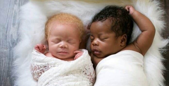 Fotógrafa dá à luz gêmeos, um negro e outra branca, e faz lindas fotos de sua filha albina