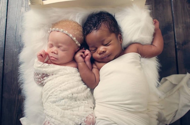 revistapazes.com - Fot&oacute;grafa d&aacute; &agrave; luz g&ecirc;meos, um negro e outra branca, e faz lindas fotos de sua filha albina